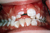 Crowded Teeth in Child