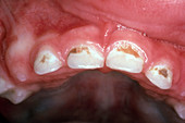 Nursing Tooth Decay