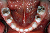 Extensive Tooth Decay in Molars