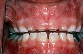 Severe Tooth Grinding Habit