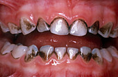 Teeth Stained from Iron Supplements