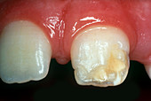 Injury to Primary Central Incisor