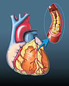Plaque-filled artery, illustration