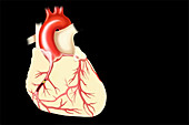 Coronary artery disease, illustration