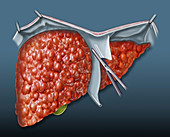 Liver transplant, illustration