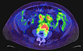 Abdominal adenopathy, CT scan