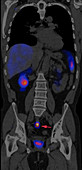 Carcinoid, coronal CT scan