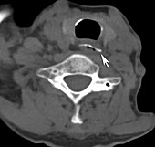 Chicken bone in esophagus, CT scan