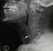 Chicken bone in esophagus, X-ray