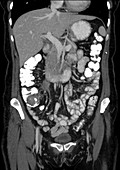 Colon carcinoma, CT scan