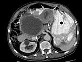 Gastrointestinal stromal tumour, CT scan
