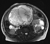 Gastrointestinal stromal tumour, MRI