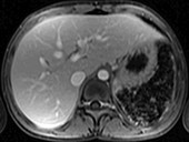 Hemochromatosis, MRI