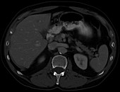 Liver metastases, CT scan