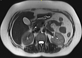 Normal pancreas, MRI