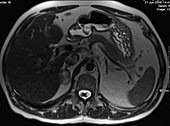 Normal spleen, MRI