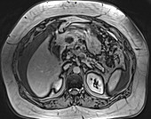 Pancreatic mass, MRI