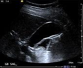 Normal gallbladder, ultrasound