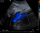 Normal inferior vena cava, ultrasound