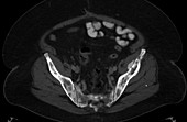 Metastases in hip, CT scan