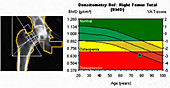 Osteoporosis, X-ray bone densitometry