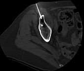 Metastasis in hip, CT scan