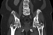 Pelvis metastases, CT scan