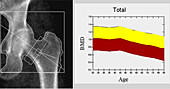 Hip X-ray and Bone densitometry