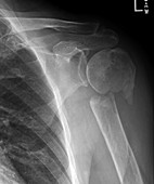 Humeral neck fracture, X-ray