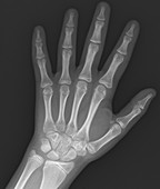 Normal hand of 13 year old, X-ray