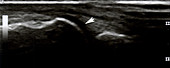 Joint effusion, ultrasound