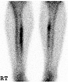Shin splints, bone scan