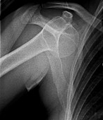 Shoulder dislocation, X-ray