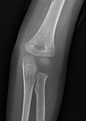 Elbow fracture in a 3 year old, X-ray