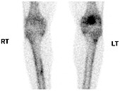 Stress fracture in tibia, bone scan