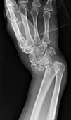 Wrist fracture, X-ray