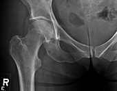 Metastasis in right hip, X-ray