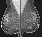Normal fibroglandular densities, mammogram