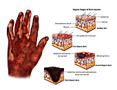 Degree Stages of Burn Injuries, illustration