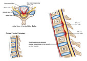 Cervical Lordosis Straightening, illustration
