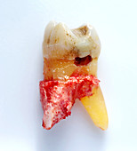 Molar with Large Side Cavity