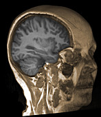 Normal brain, 3D MRI