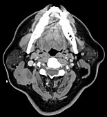 Metastatic cervical lymph node, CT scan