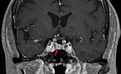 Microadenoma, MRI