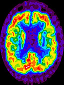 Alzheimer's, PET scan