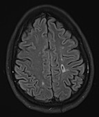 Multiple sclerosis, MRI