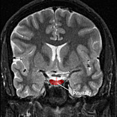 Normal pituitary, MRI