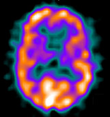 Normal brain, SPECT CT scan