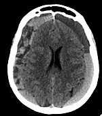 Subdural hematoma, CT scan