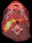 Tongue cancer, PET CT scan